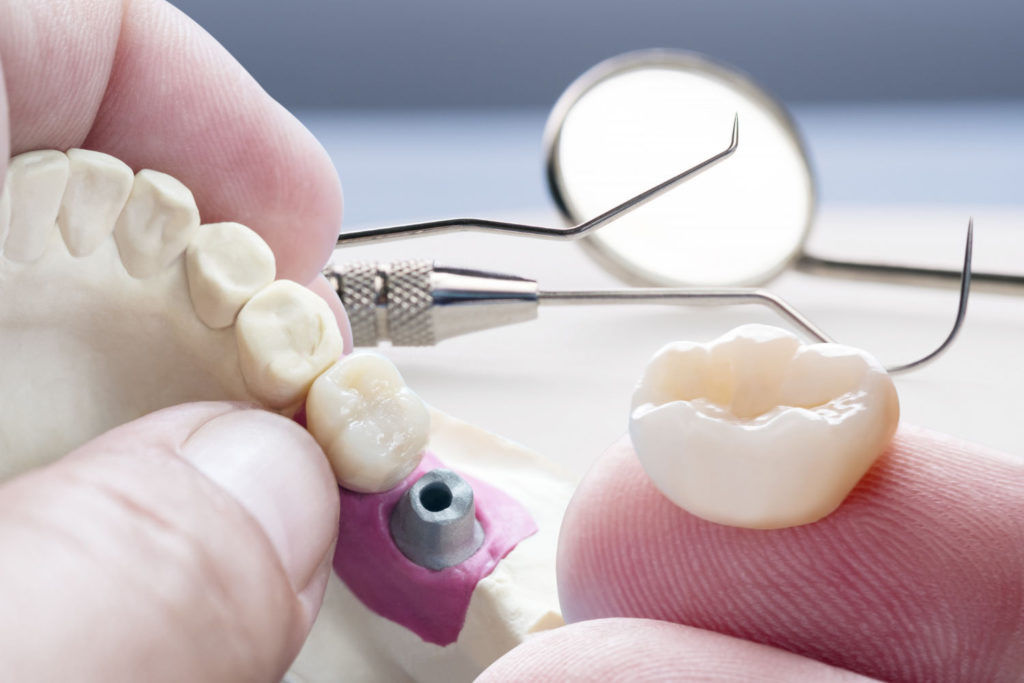 Protetyka to dział stomatologii, który zajmuje się wykonywaniem i naprawą protez zębowych