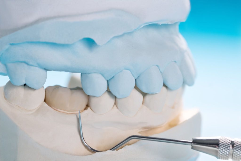 Protetyka stomatologiczna jest dziedziną, która zajmuje się odtwarzaniem funkcji i estetyki zębów za pomocą protez.