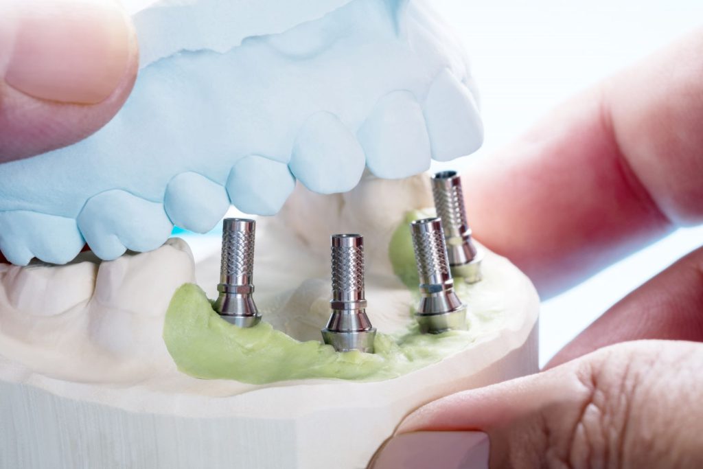 Protetyka stomatologiczna jest dziedziną, która zajmuje się odtwarzaniem funkcji i estetyki zębów za pomocą protez.